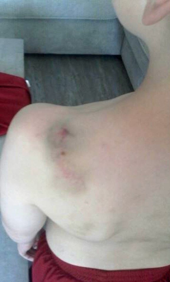 A picture shows horrific bruising on Arthur's shoulder