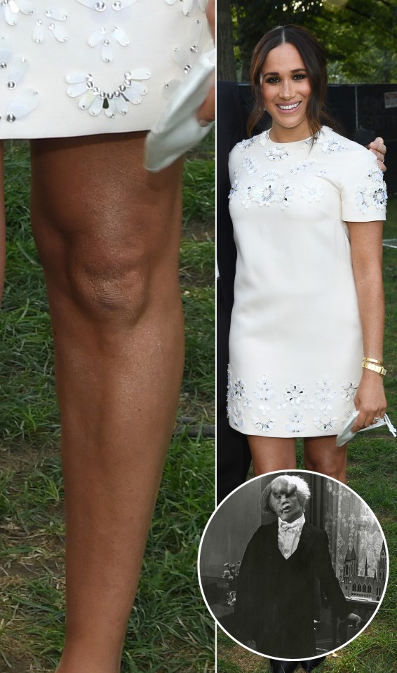 Meghan Markle knee gives a good likeness of John Hurt as the Elephant Man