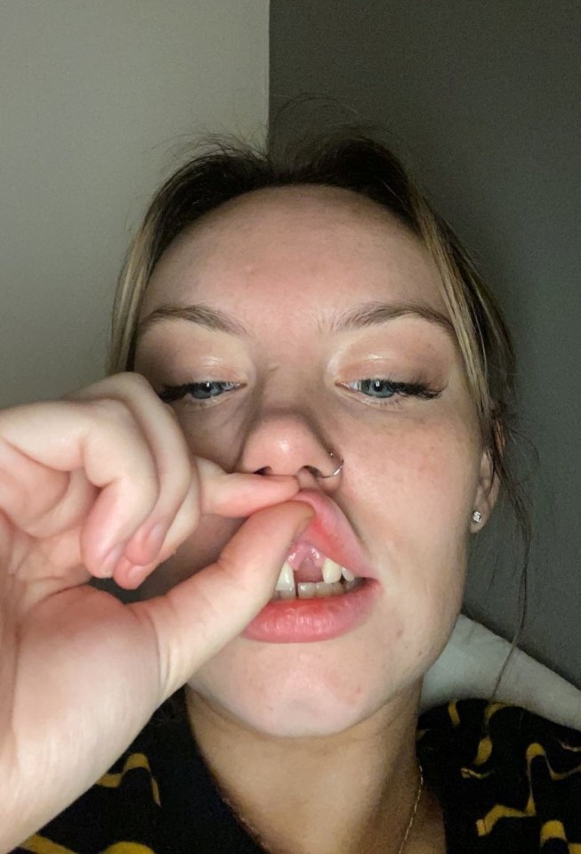 She now has to pay £4,800 to replace her tooth at a private dentist as her procedure is not covered by the NHS