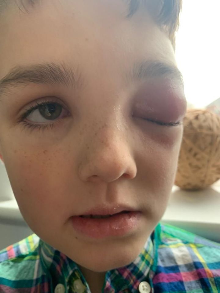 Zac had a very rare allergic reaction to Covid-19 despite no other symptoms