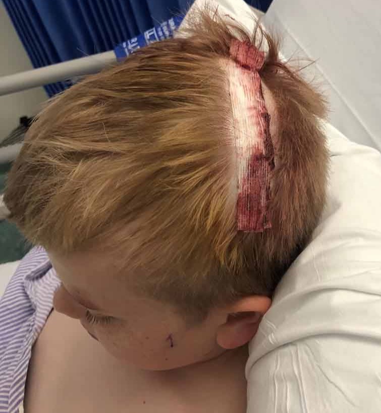 In the nine months since his shocking diagnosis, George has had four brain operations in two countries. His head is pictured after a 10-hour operation to remove the tumour