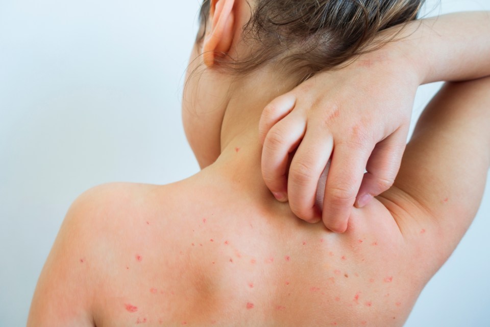 UK health chiefs warn measles could bounce back in Britain unless kids' vaccine rates increase