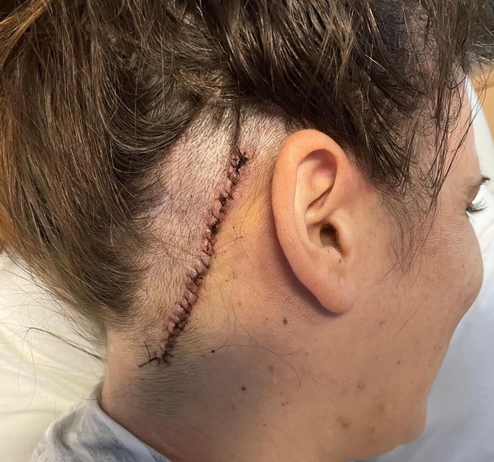 Jessica  had to undergo a 13-hour operation where surgeons removed a section of her skull from behind her ear, and successfully took out most of the tumour