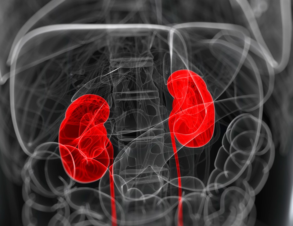 Kidney cancer is often found too late as people don't realise they have symptoms