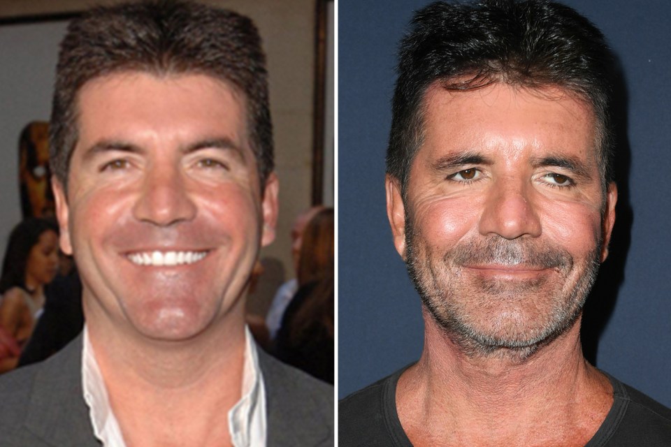 Simon Cowell admitted overdoing the Botox while filming X Factor