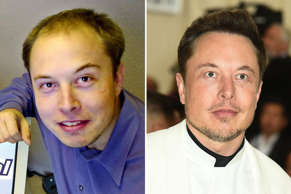 Billionaire Elon Musk has had hair treatment to combat his balding noggin