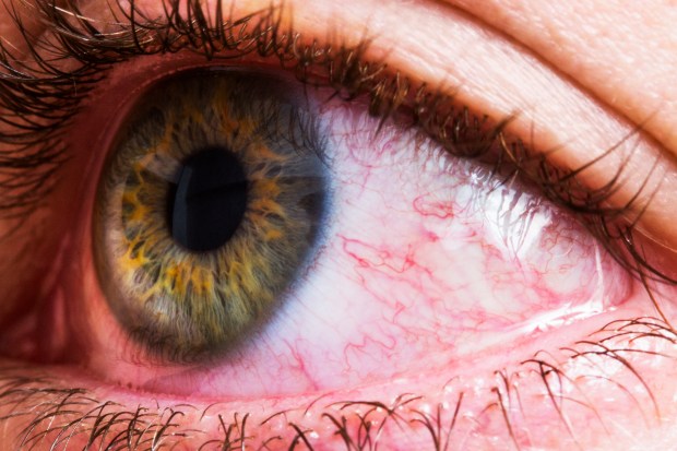 a close up of a woman 's eye with red veins