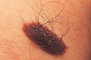  Example of a healthy mole