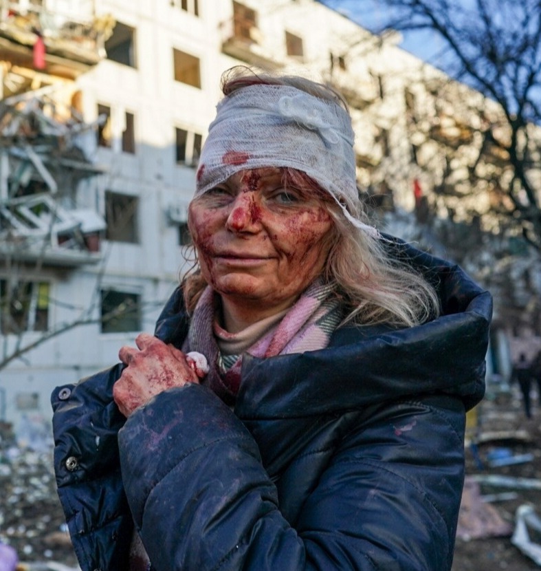 A woman injured in the shelling of Chuhuiv on February 24