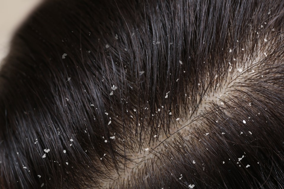 Dr Adam says: ‘Severe dandruff can indicate a weakened immune system, which can be caused by stress or lack of sleep’