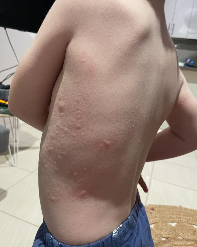 This is a picture of a rash sparked by an allergic reaction to dairy