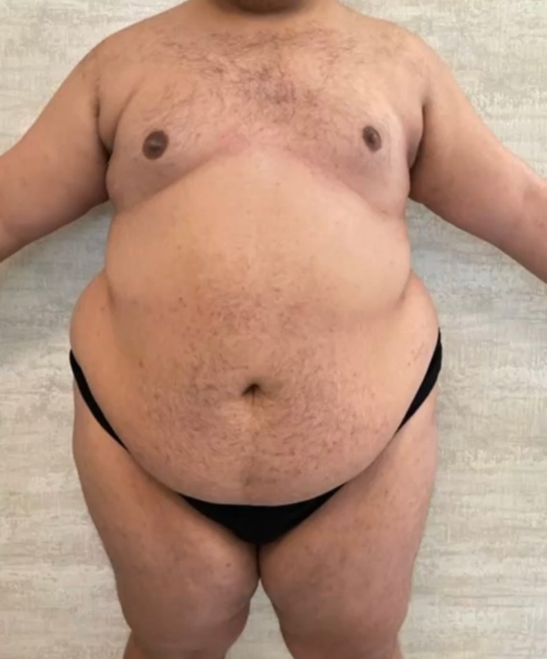 Chad reached such a low point, that he felt surgery was the only way out. He approached 30 surgeons but they were all reluctant to operate on him due to his size