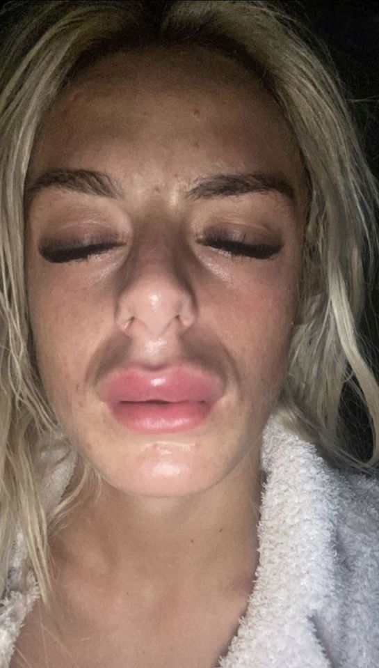 Her colleagues were concerned the lip would begin to lose oxygen