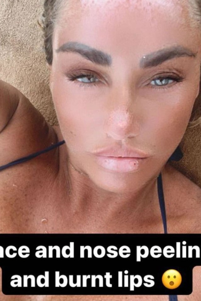 Katie shared her painful sunburn with fans