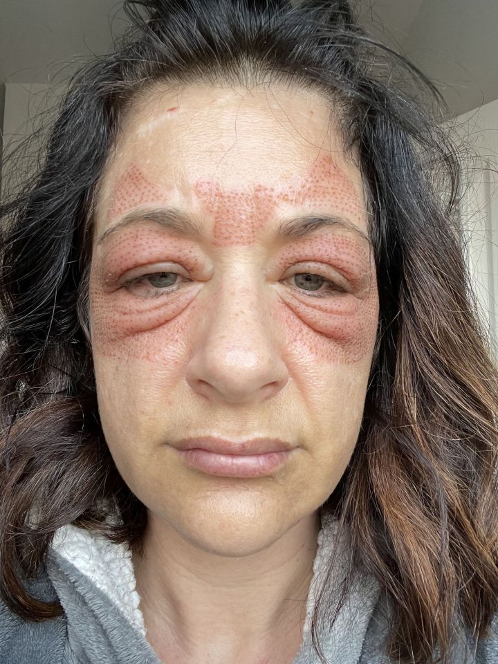 The mum was left with scarring and swelling across her face