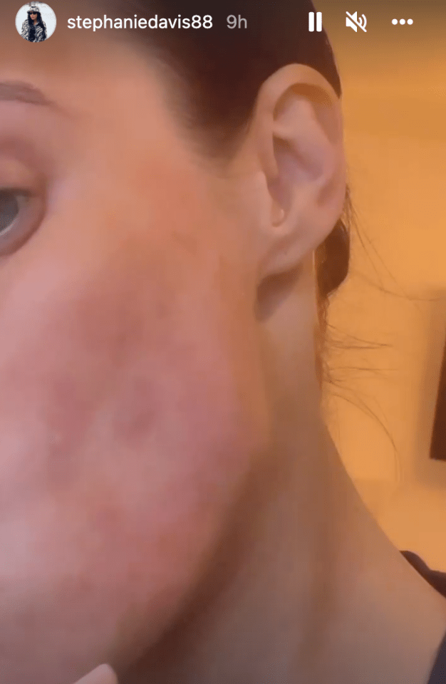 She showed off patchy and inflamed skin around her jawline