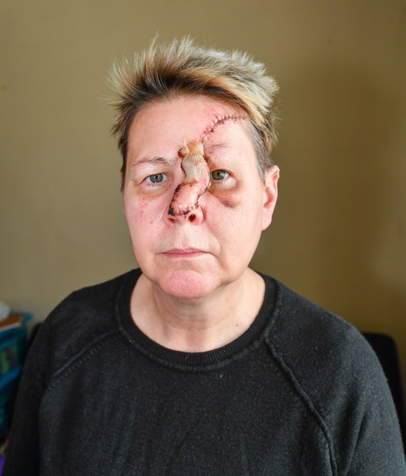 Sam was bitten by a dog and had to have reconstruction on her face following the horror ordeal