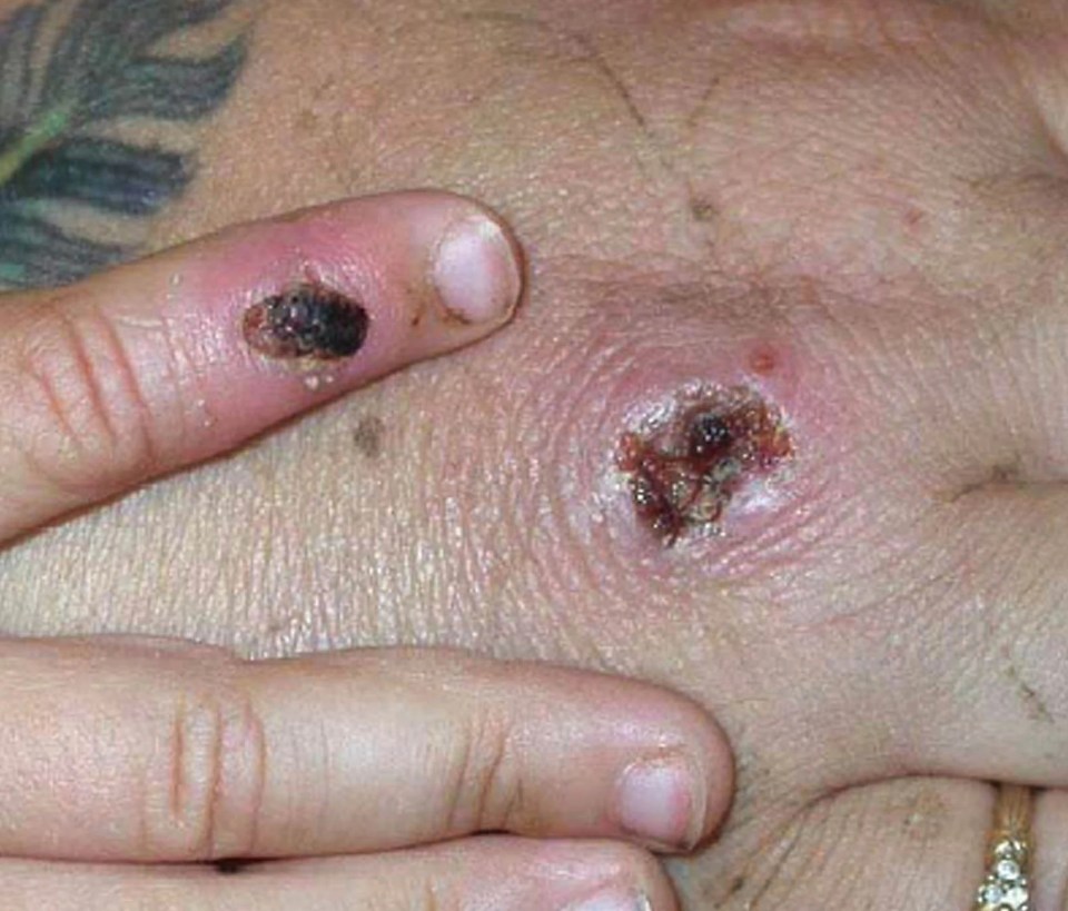 Monkeypox scabs in the later stages of a rash. A person is still contagious until these scabs fall off