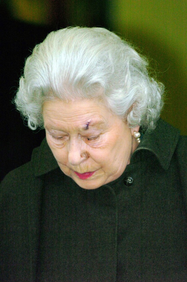 The Queen was snapped leaving hospital to remove a lesion from her eyebrow in 2003