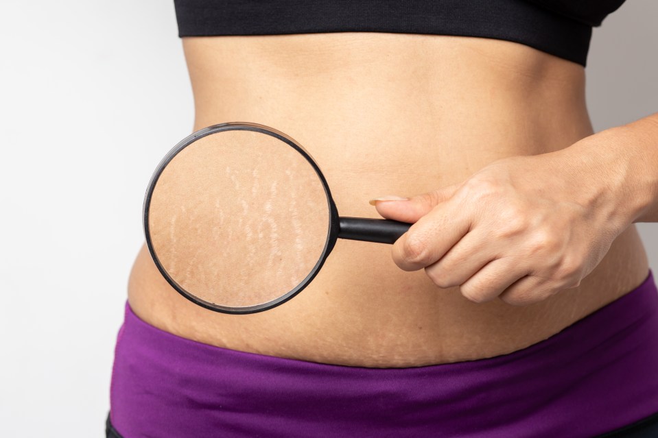 Women worry about acne, wrinkles and stretch marks all the time