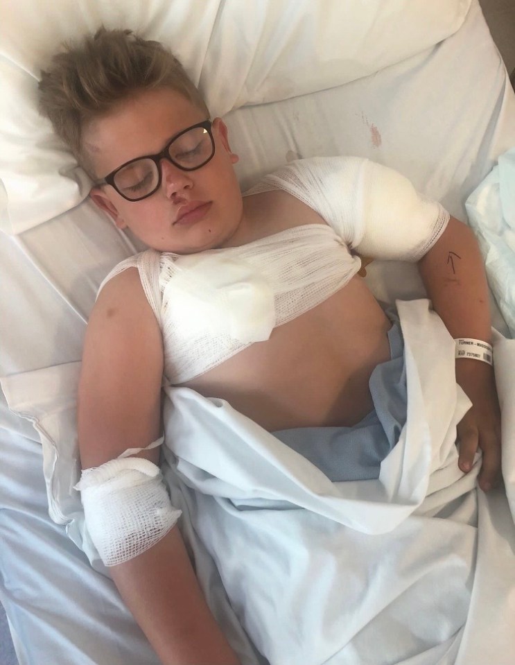 Freddie Turner needed plastic surgery after suffering in a dog attack