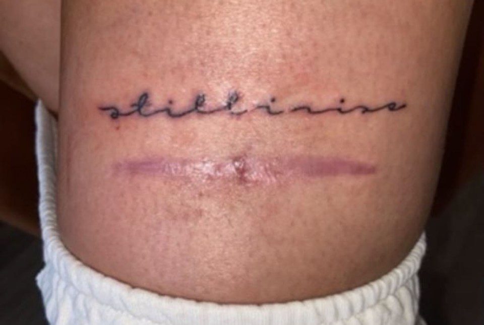 The scar on Shannon's leg (above her knee) where the cancer was cut out