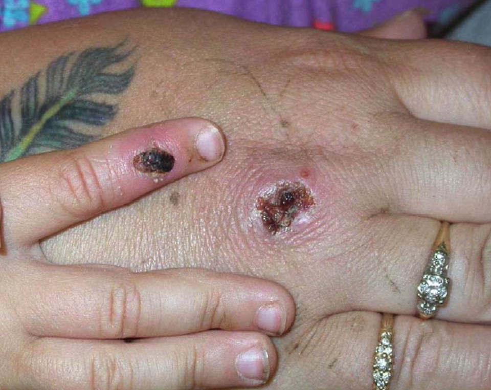 A Brit tourist on the Canary Island of Fuerteventura is being tested for monkeypox