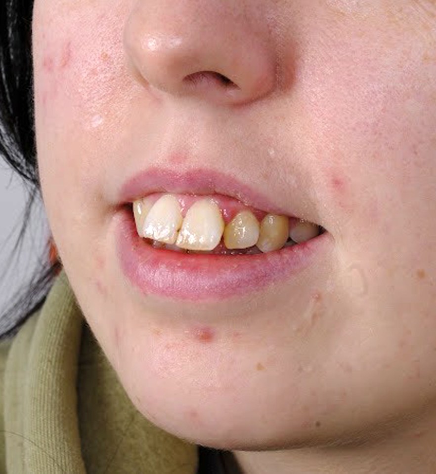 Getting married this year, Kellie didn't want to look back at her wedding photos with regrets and hide from the camera so took the plunge to get her teeth done