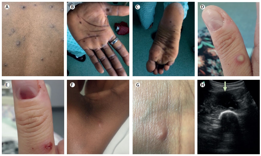 Examples of monkeypox lesions