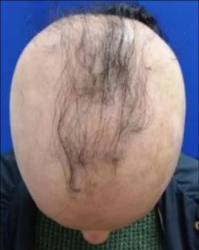 Patient with alopecia before