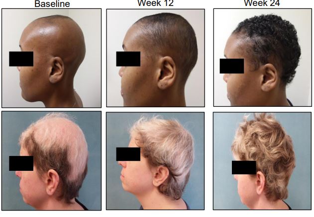 Patients’ hair growth after six months