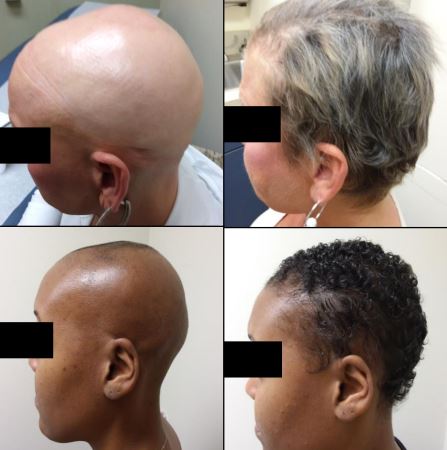 Patients’ hair growth after six months