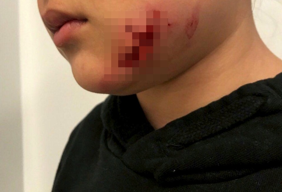 The schoolgirl suffered a deep cut to her face after being attacked by the dog