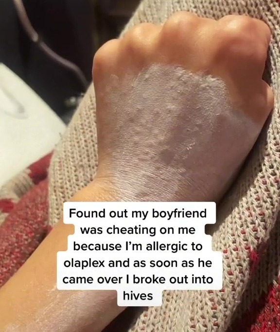 The woman was convinced her man had been cheating on her after she had an allergic reaction to Olaplex