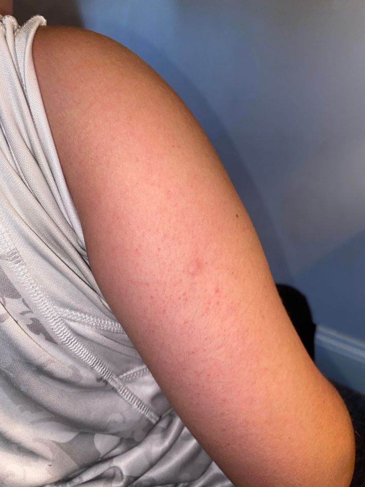 The 12-year-old's suspected heat rash five days later