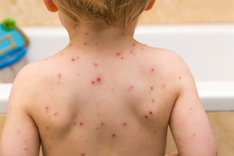 Chickenpox can be uncomfortable for little ones, but one doctor said there is a way to soothe it