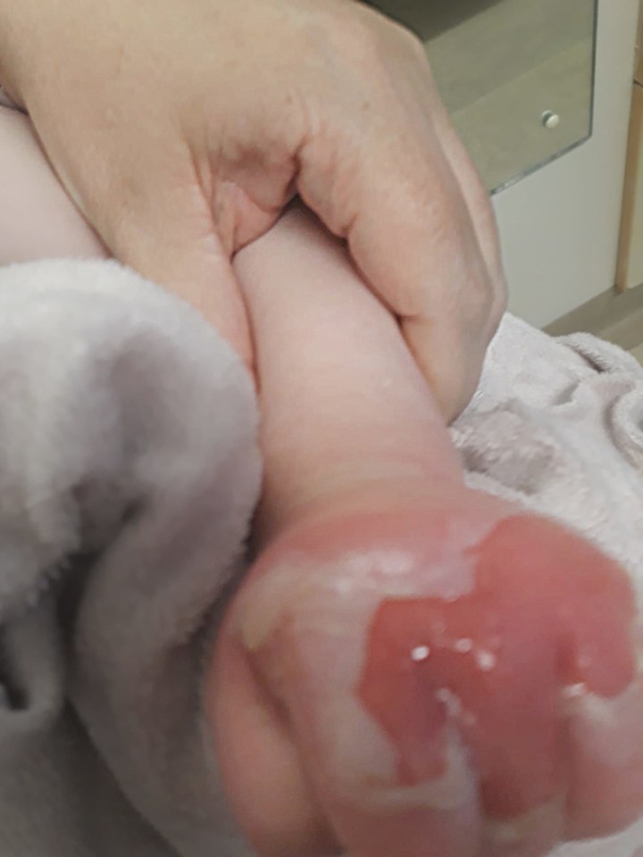 Giant hogweed can cause severe burns and blisters that can last for years, as seen on 22-month-old Emma