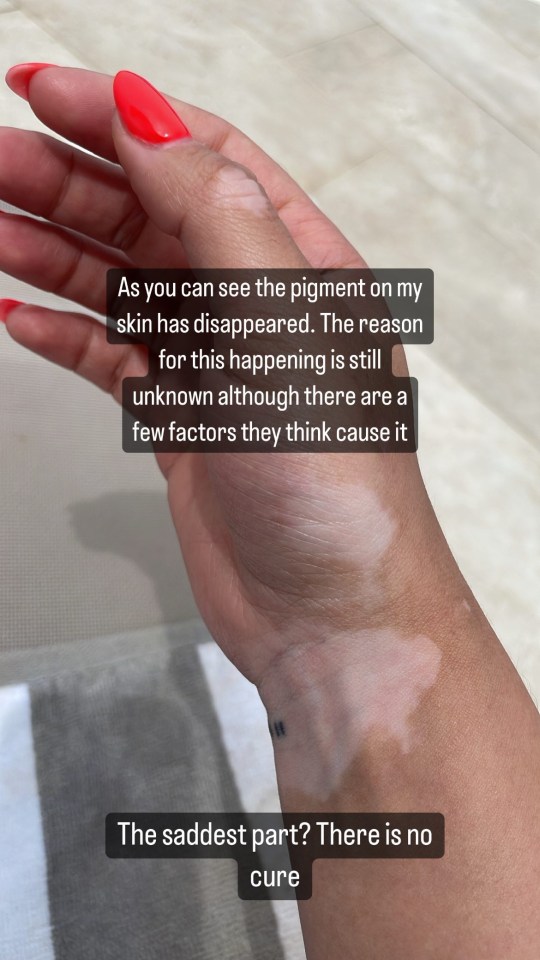 The actress shares snaps of the discolouration on her skin