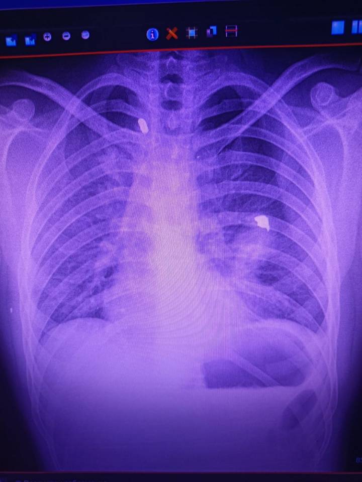 X-rays showed two shards of metal had lodged inside his lungs after tearing through his back