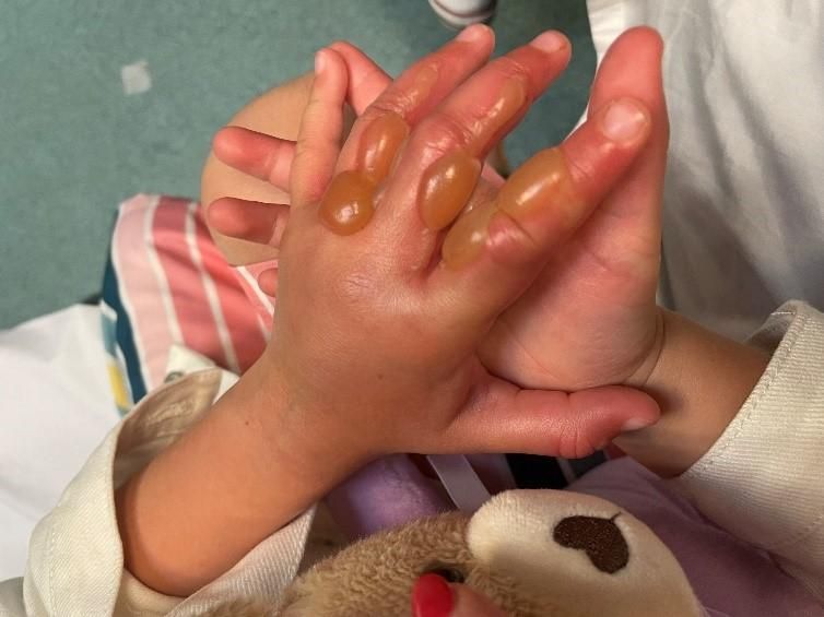 A Hardy Mill Primary School Student suffered horrendous burns after touching giant hogweed