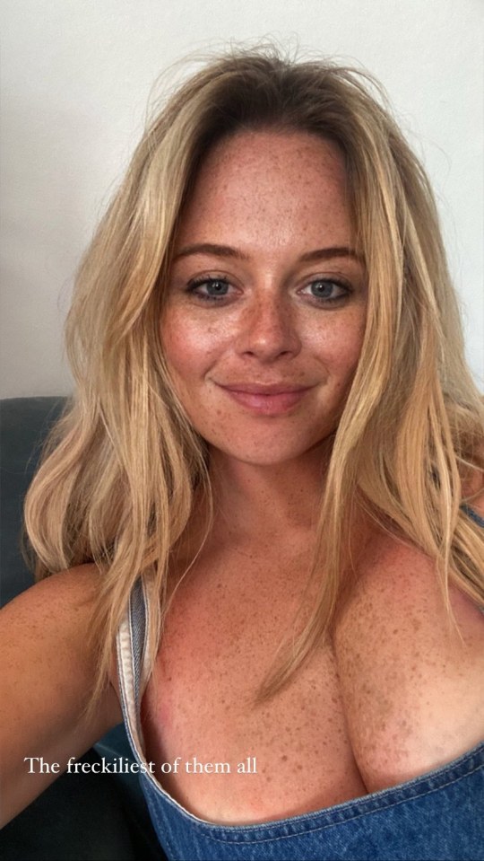 Emily Atack showed off her freckles after her holiday