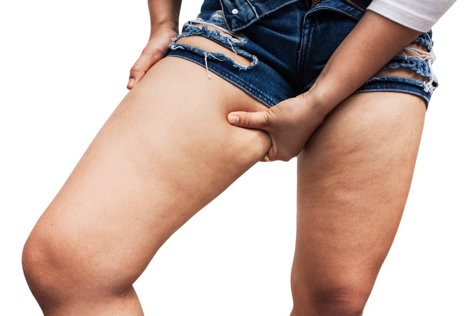 Thigh chafing can commonly occur in hot weather, leaving many woman uncomfy and frustrated