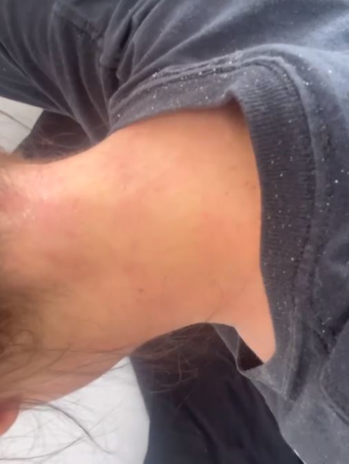 The actress showed the sore wounds on her neck