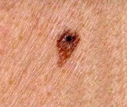 A melanoma mole