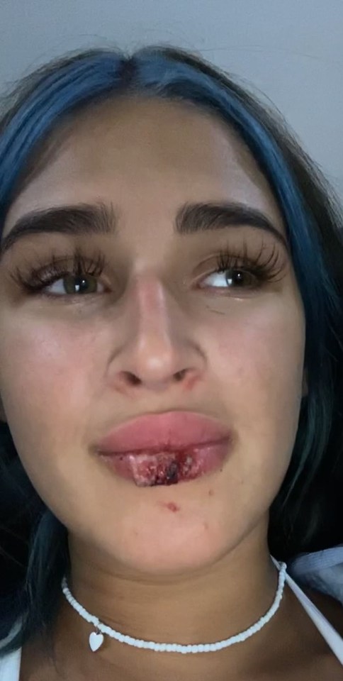 Ellie saw a doctor who said her lip fillers may have made her more prone to burning