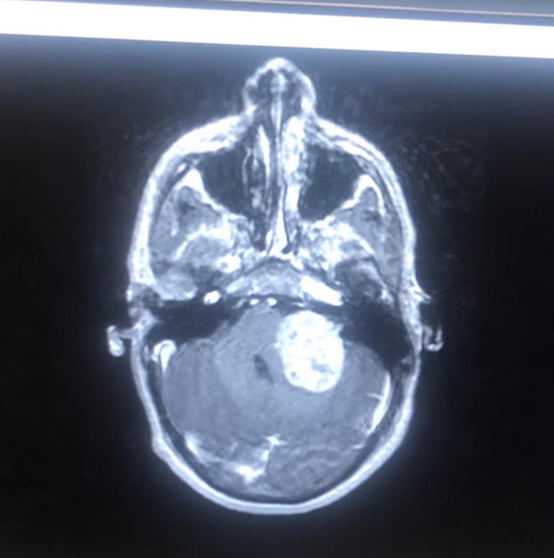 The tumour in Jayce's brain that was causing dizziness, nausea and hearing loss