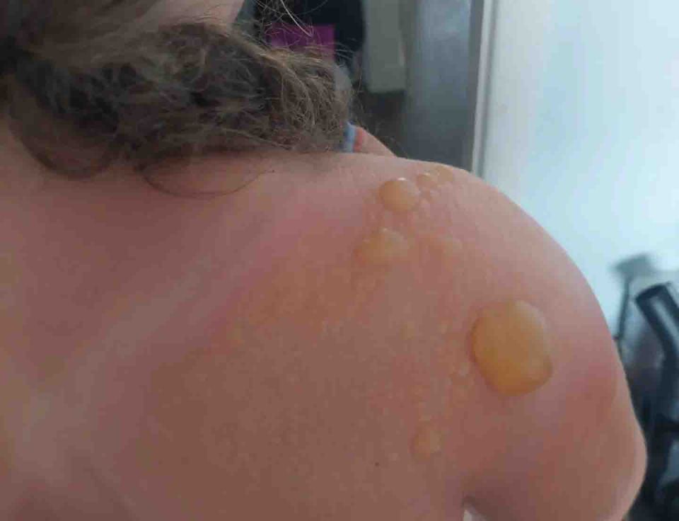 Jasmine Williams says her daughter was 'screaming in agony' in minutes of going out to play in the garden despite putting on factor 50 sunscreen