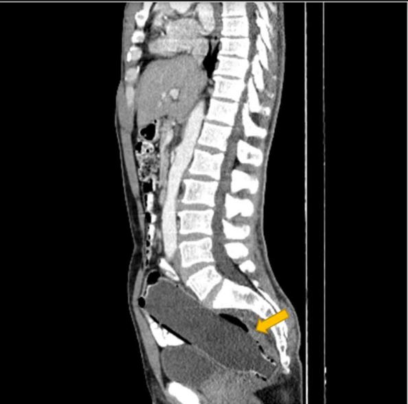 Doctors discover the cause of a man's three-day constipation (pictured, the CT scan)