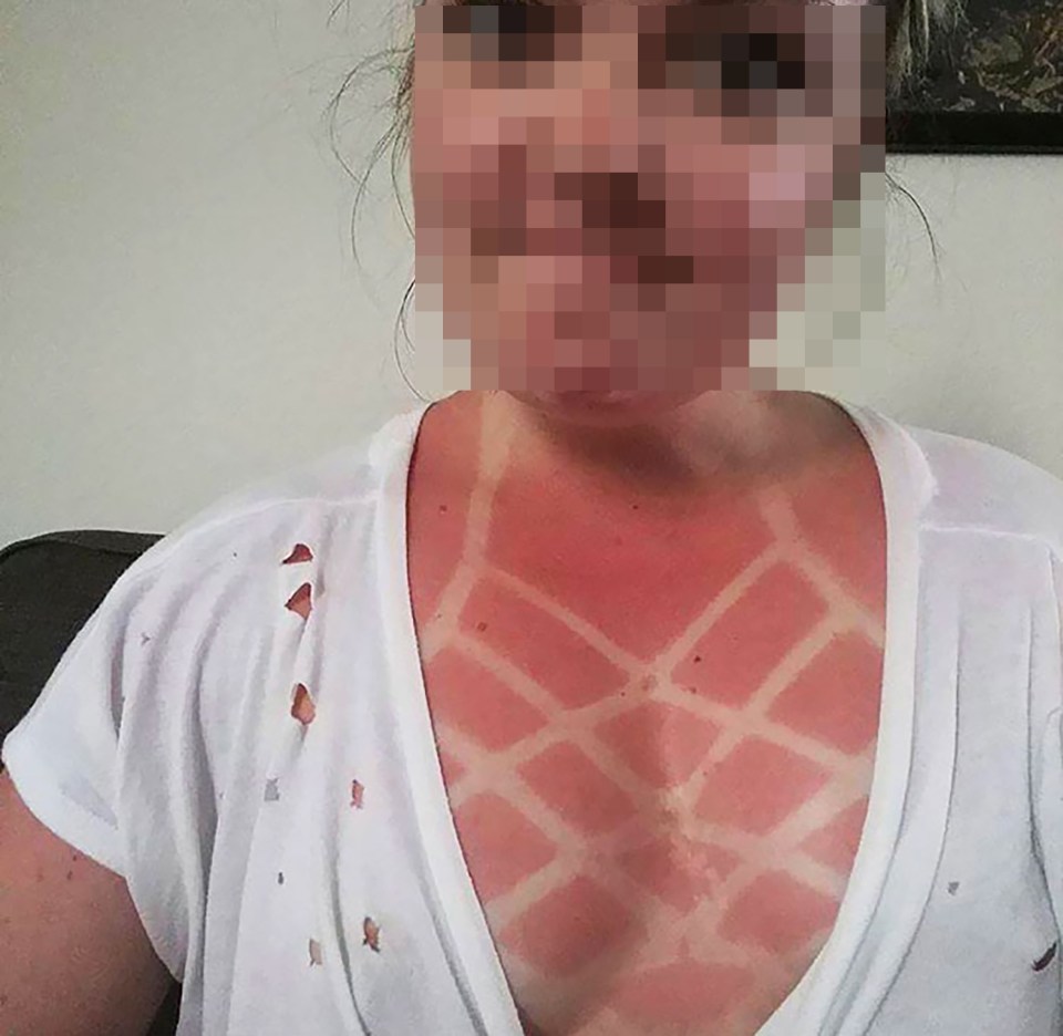 One woman was left with a criss-cross pattern imprinted on