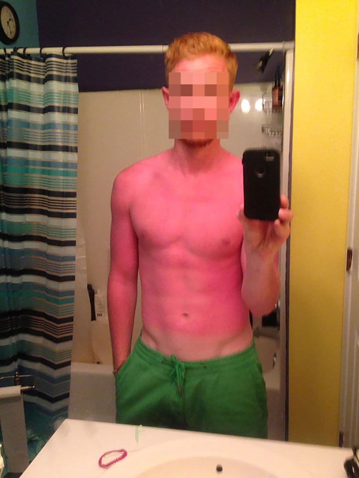 One man was forgot to put any sun protection on and was left with burns all over